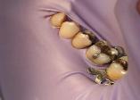 A rubber dam protects the oral cavity