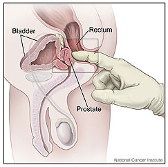 Digital Rectal Exam of the Prostate Gland