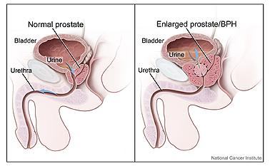 Normal and Enlarged Prostate