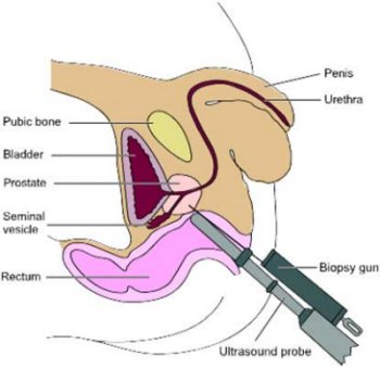 Prostate Biopsy
